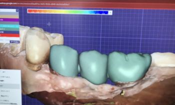 型取りのないインプラント治療の画像