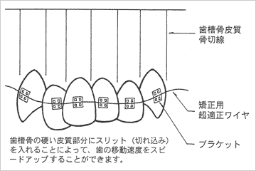 コルチコトミー