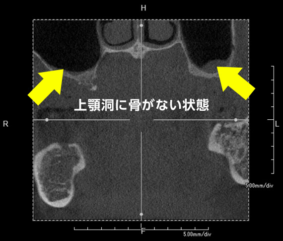 上顎洞挙上術（サイナスリフト・ソケットリフト）上顎洞に骨がない状態