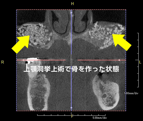 上顎洞挙上術（サイナスリフト・ソケットリフト）で骨を作った状態