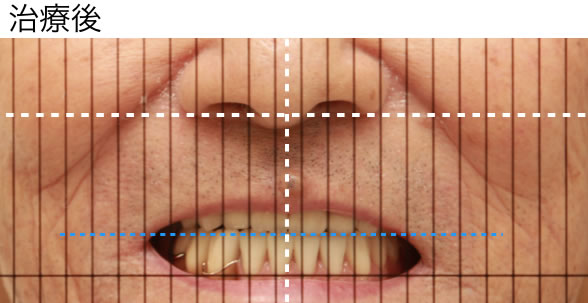 自費診療で精密に作られた入れ歯装着時