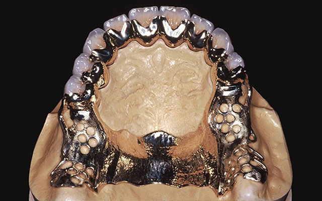 自費診療で精密に作られた入れ歯装着時
